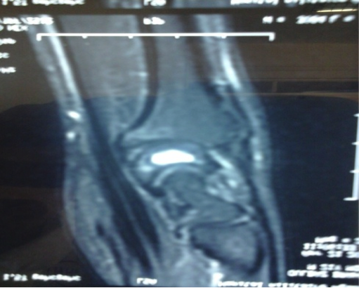 Kyste synovial du lunatum révélé par un traumatisme : à propos d’un cas et revue de la littérature Figure 3