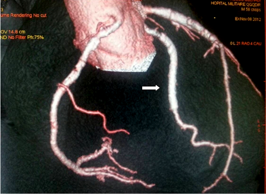 Bloc auriculo-ventriculaire chez les patients hémodialysés: à propos de quatre cas Figure 1