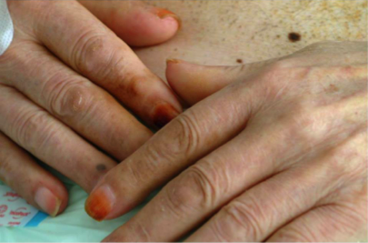 Síndrome de las uñas amarillas de evolución fatal Figura 5