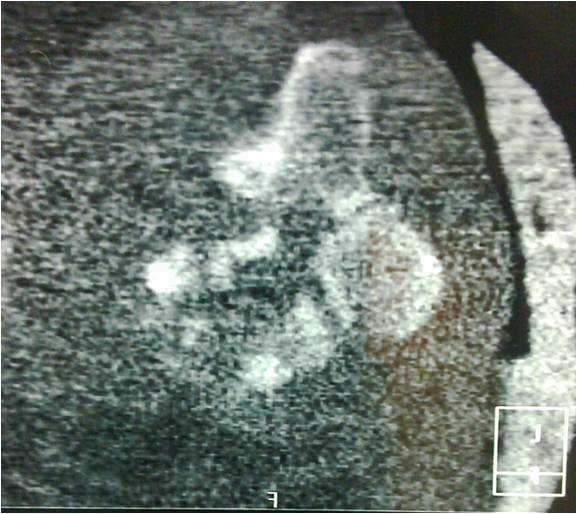 What is the treatment for degenerative scoliosis picture