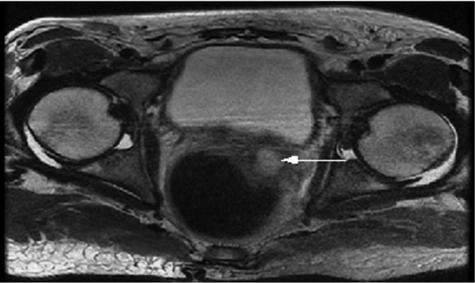 Asymptomatic seminal vesicle abscess revealed by diabetic ketoacidosis