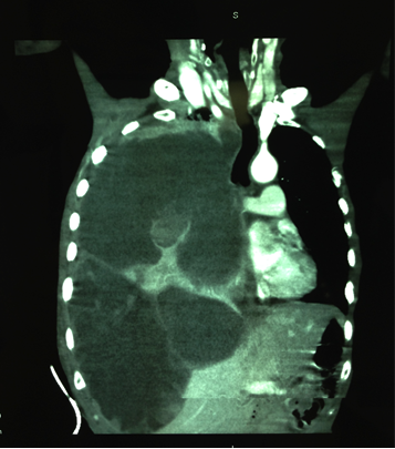 Coexistence of Neurofibromatosis Type-1 and Primary Pulmonary Sarcoma: A Case Report and Review of the Literature figure 4