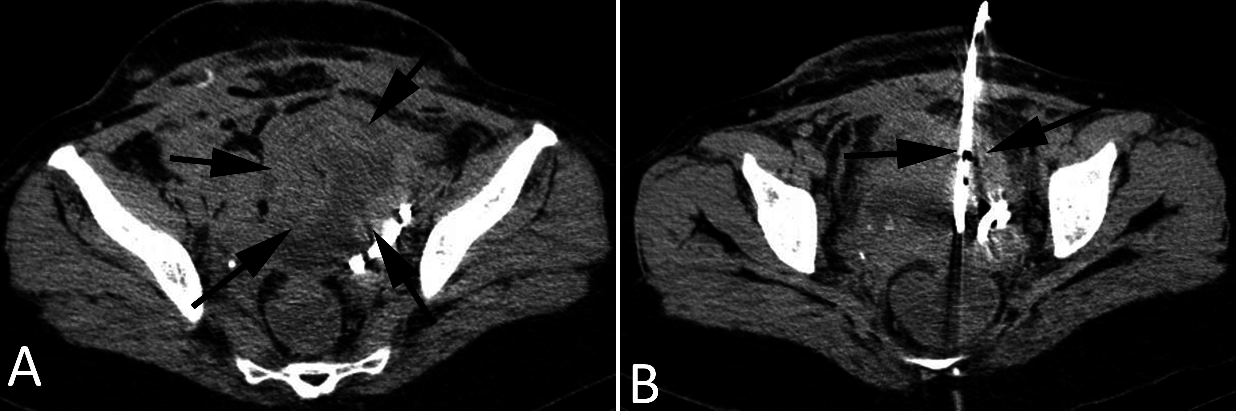Computed tomographyguided percutaneous drainage of a pelvic abscess