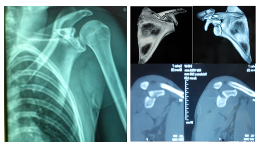 Bennett fracture osteosynthesis 03 picture