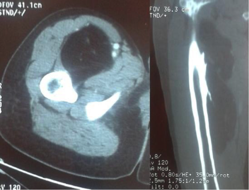 Le lipome parostéal du fémur : une situation clinique rare Figure 3