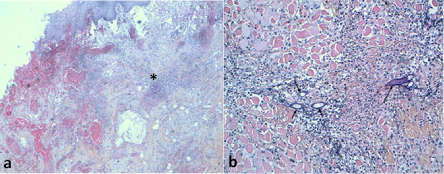 Mucormycose rhino-cérébrale : à propos d’un cas Figure 3