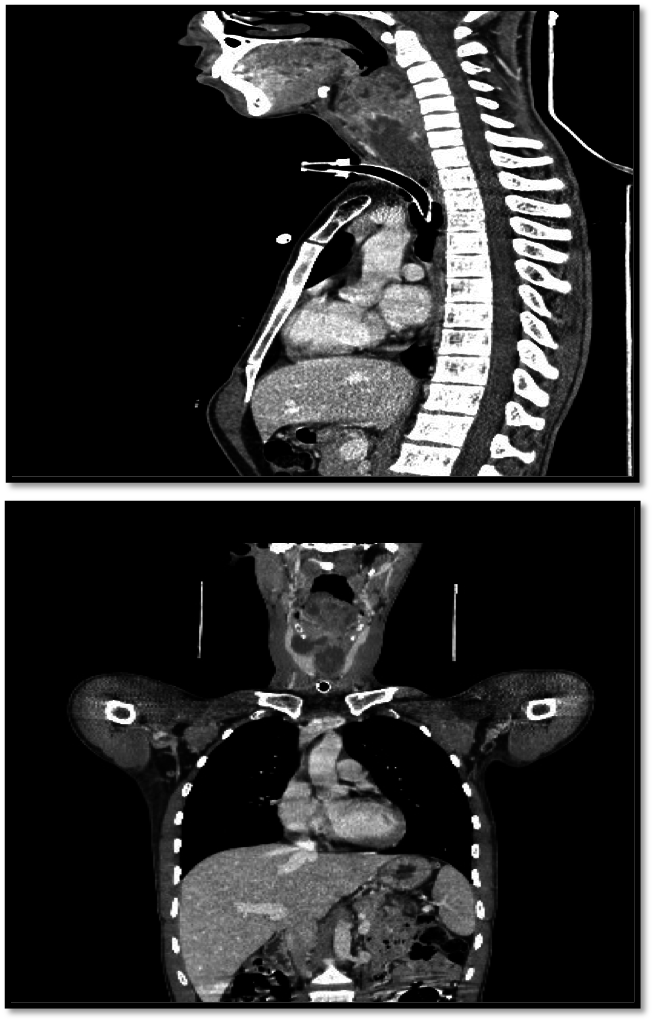 Leiomyosarcoma of larynx: two new cases report and review of literature figure 1