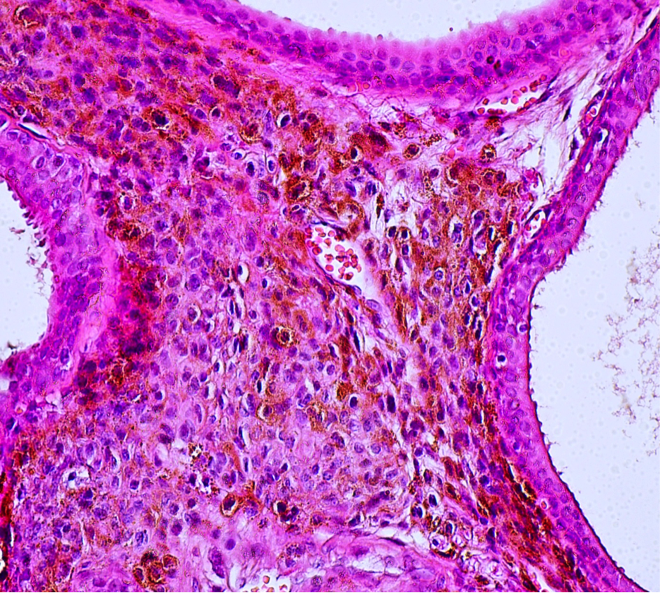 pterygium histology