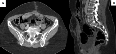 Metastase Peritoine Pronostic