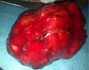 Unusual location of a hydatid cyst figure 3