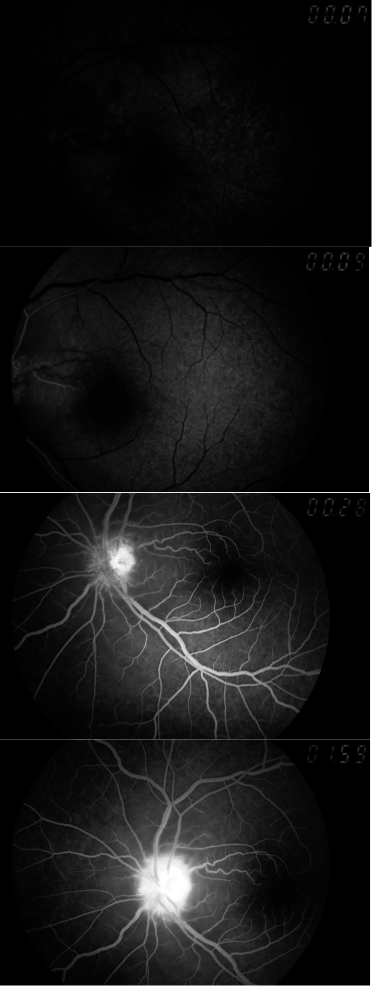 Non-arteritic ischemic optic neuropathy reveals Marchiafava–Micheli disease: a case report figure 3
