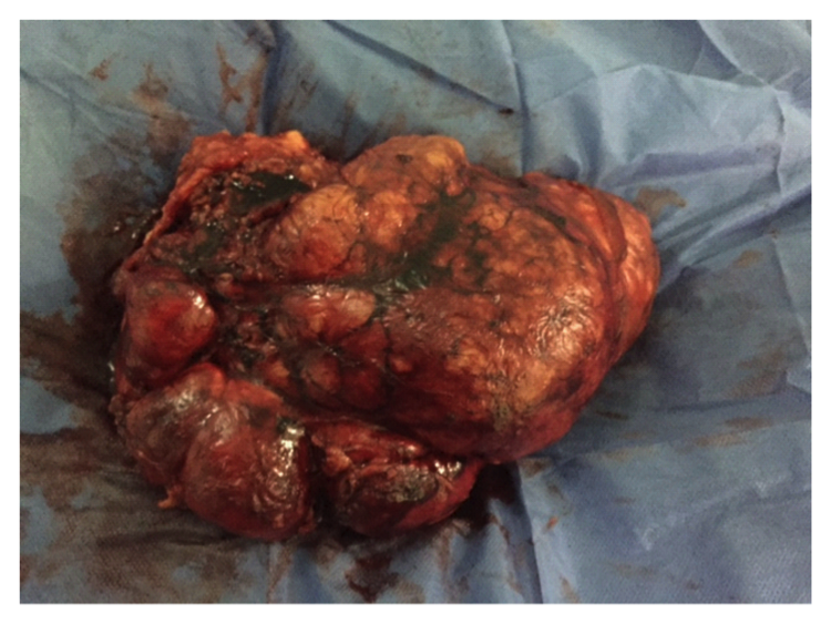 Angiomiolipoma renal bilateral y esclerosis tuberosa de bourneville: reporte de un caso y revisión de la literatura Figura 2