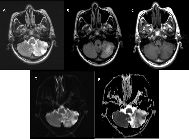Electrocardiographic Changes in a Patient with Left Cerebellar Infarction figure 1