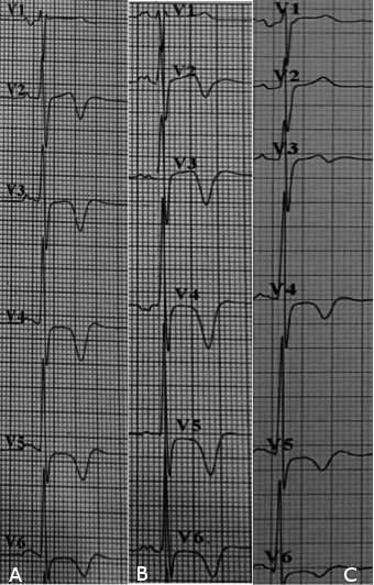 Electrocardiographic Changes in a Patient with Left Cerebellar Infarction figure 5