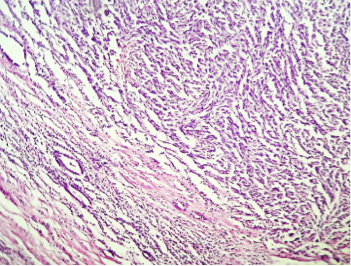 Low-grade tubular-mucinous kidney carcinoma: Case Report and literature review figure 1