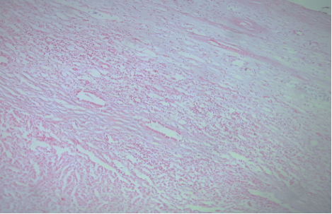 Low-grade tubular-mucinous kidney carcinoma: Case Report and literature review figure 6