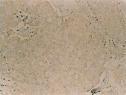 Etude du statut HER2/neu  par méthode immunohistochimique chez  85 patients atteints  du cancer du sein  Figure 1