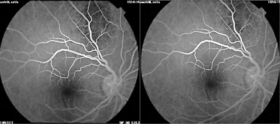 Pitfalls In The Diagnosis Of Choroidal Tumors 3 Case Reports Masses Figure 7 Pitfalls In The Diagnosis Of Choroidal Tumors 3 Case Reports Masses Figure 7