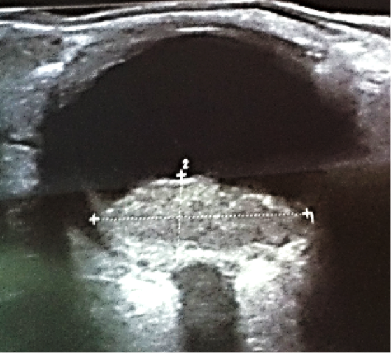 Pitfalls in the diagnosis of choroidal tumors: 3 case reports of choroidal masses figure 9