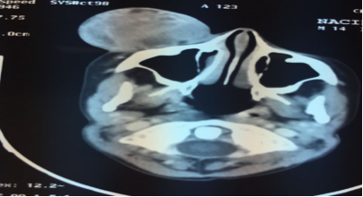 Rhabdomyosarcome orbitaire de l’enfant : A propos d’un cas Figure 1