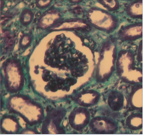 Glomérulonéphrite membranoproliférative associée à une hépatite virale B occulte Figure 2