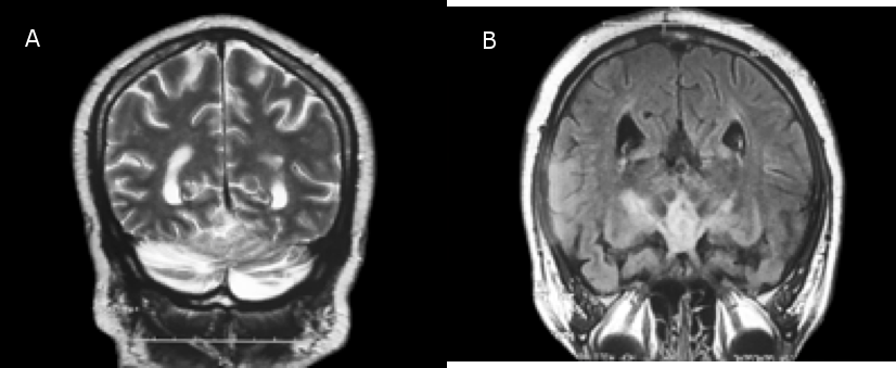 Insuffisance rénale aiguë associée à une sarcoïdose multi-viscérale Figure 1