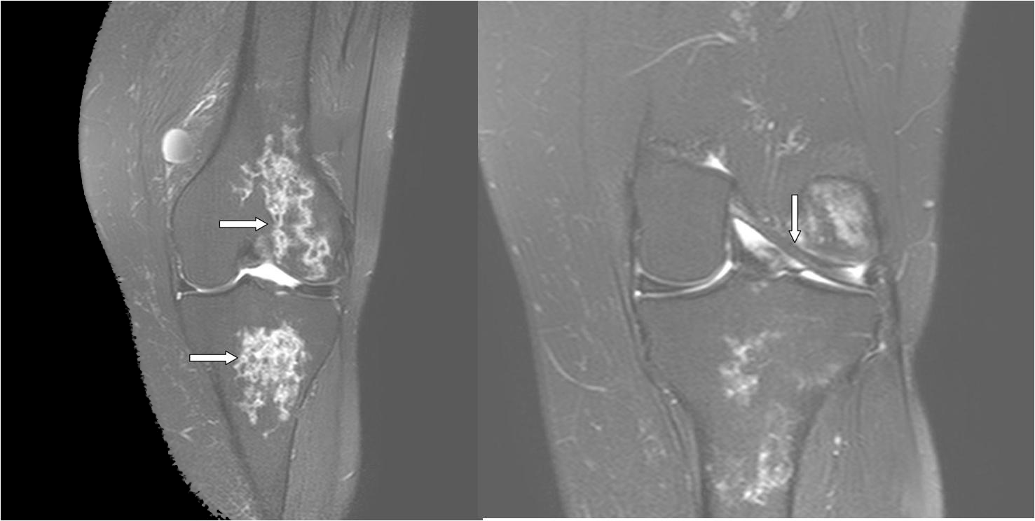 Mri Acl Tear