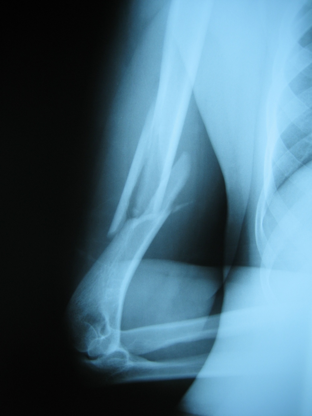 Refractory humeral pseudoarthrosis: case report figure 1