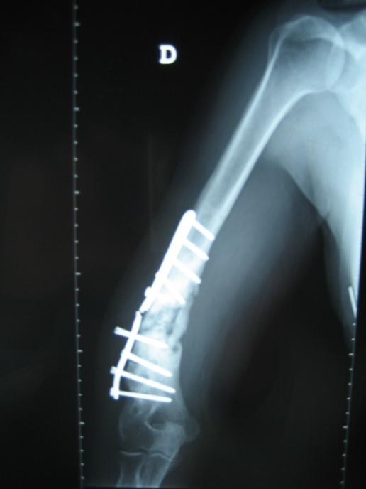 Refractory humeral pseudoarthrosis: case report figure 3