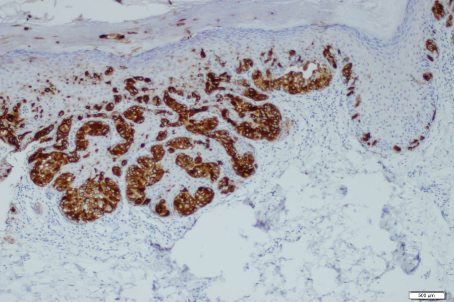 Primary cutaneous vulvar Paget’s disease a case report