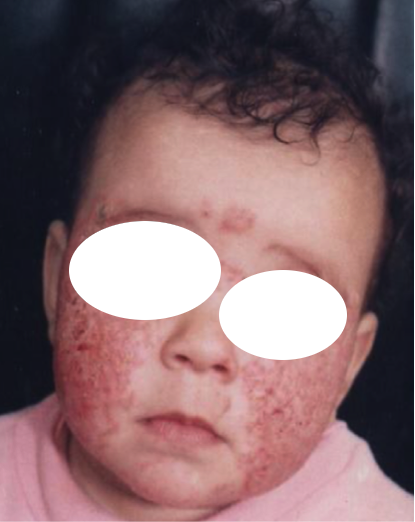 Comme passent les taches au psoriasis