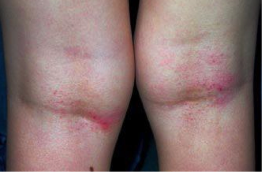 Est semblable au psoriasis