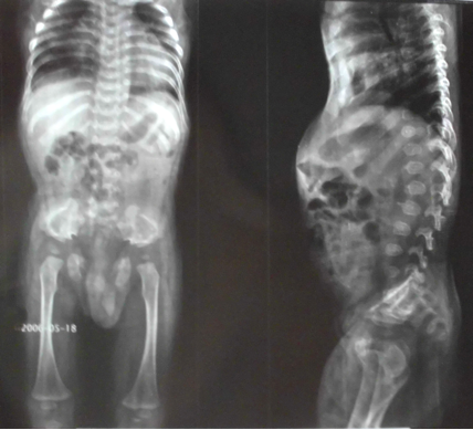 A rare case of complicated osteopathy figure 2