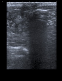 Prenatal diagnosis of fetal intra-abdominal umbilical vein varix figure 4