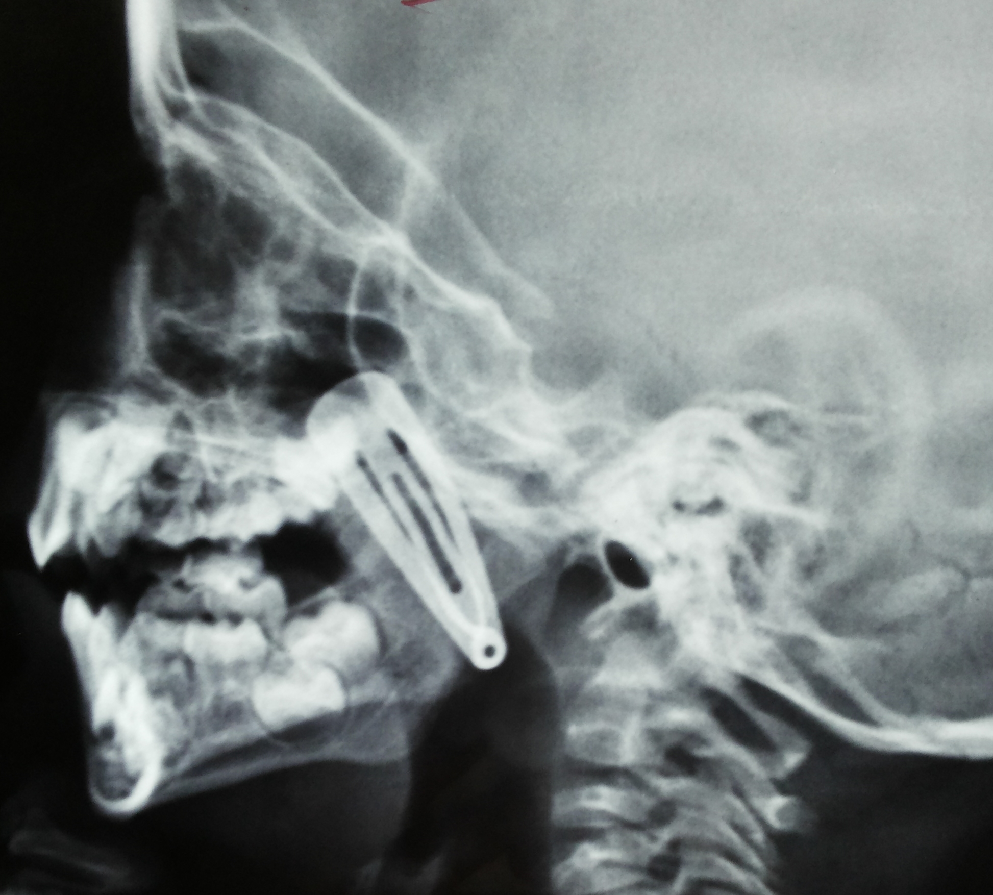 Top 96+ Wallpaper Cpt Code For Removal Of Foreign Body With Tweezers