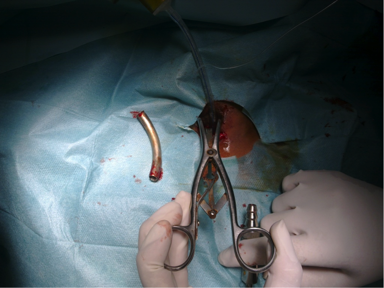 Corps étranger bronchique inhabituel : canule de trachéotomie Corps étranger bronchique inhabituel : canule de trachéotomie